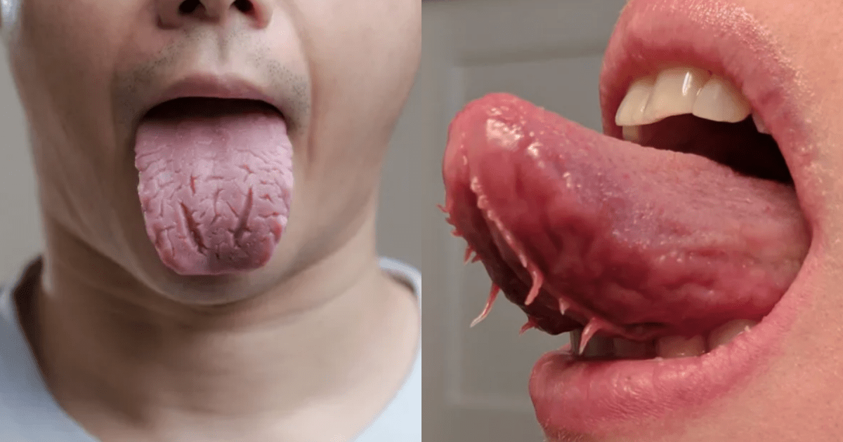 Do Some People Really Have Tentacles Under Their Tongue?