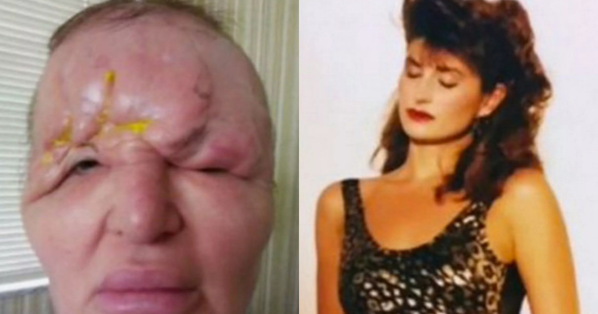 Carol Bryan Left 'Unrecognizable' After Botched Treatment Causes Severe Facial Collapse