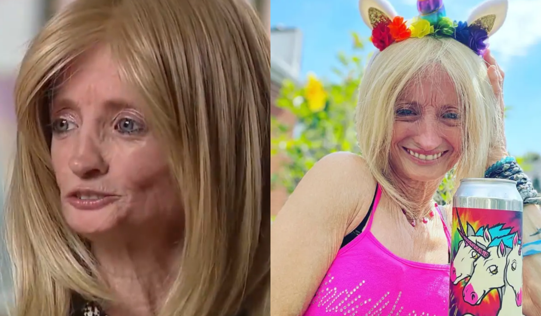 Woman, 46, With Rare ‘Benjamin Button’ Disease Ages Eight Times Faster Than Average