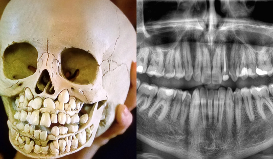 People Shocked And Horrified After Seeing What A Child’s Skull Looks Like