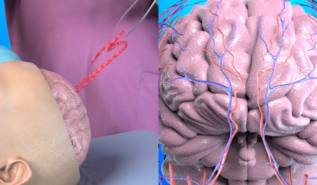 ‘Worst Nightmare’ Simulation Reveals How A Woman Ended Up With A 3-Inch Worm In Her Brain After Eating Vegetables