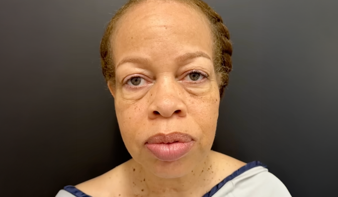 Woman Transforms Her Look With Full Face Rejuvenation And The Results Are Astonishing