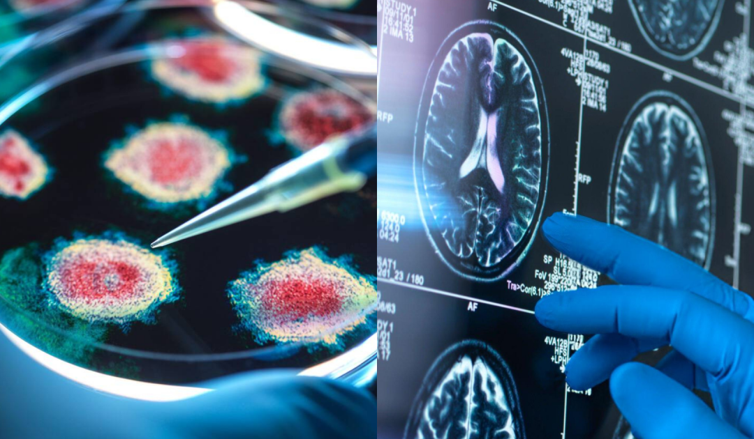 Common Virus Linked To Alzheimer’s In Some Individuals